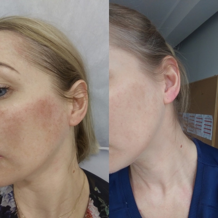 Peeling medyczny Perfect Peel