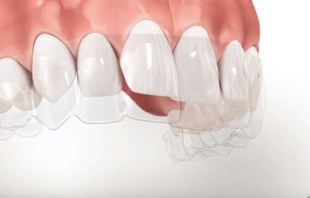Clear Aligner